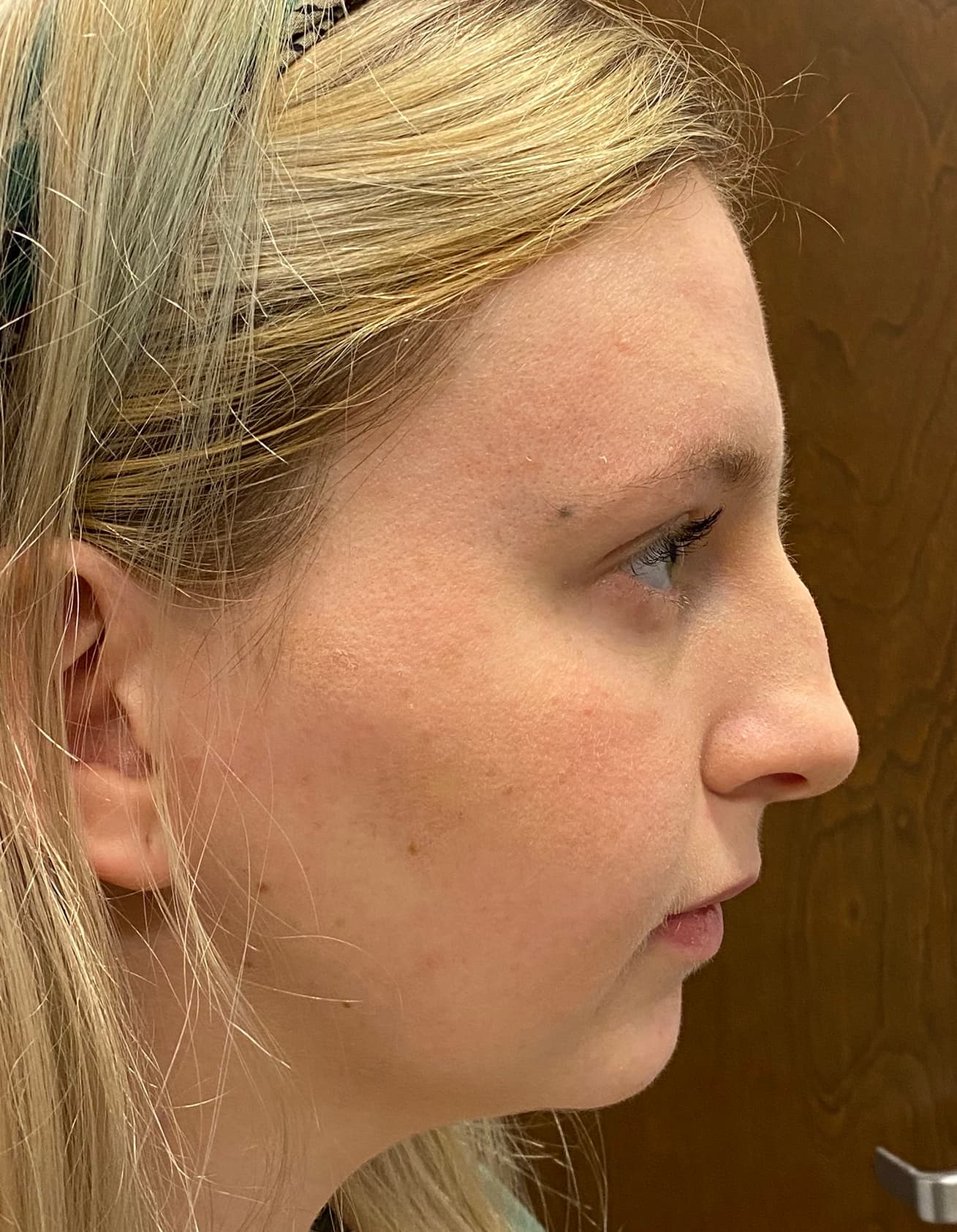 rhinoplasty before, patient 87168871, Dr. Shari Reitzen, New York