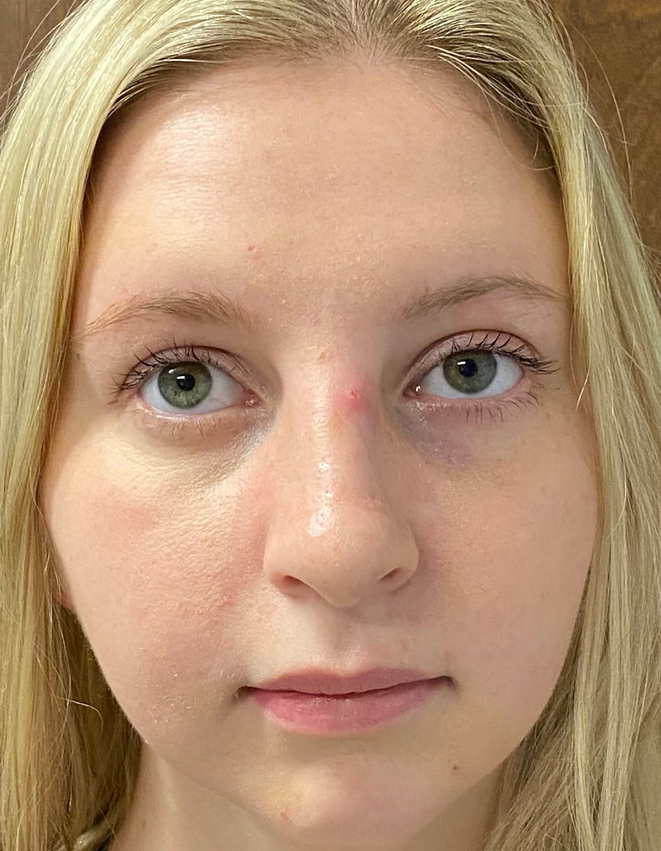 rhinoplasty after, patient 87168871, Dr. Shari Reitzen, New York
