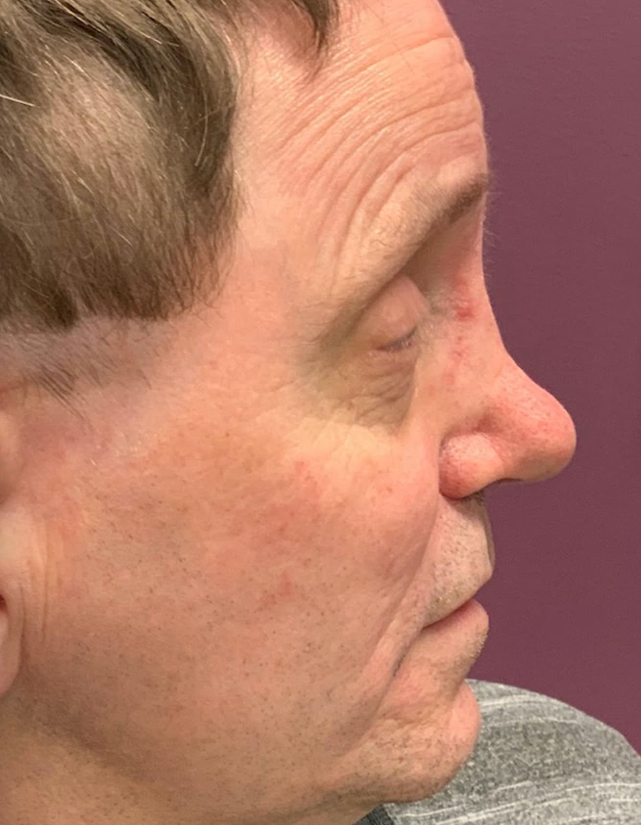 rhinoplasty before, patient 87168867, Dr. Shari Reitzen, New York