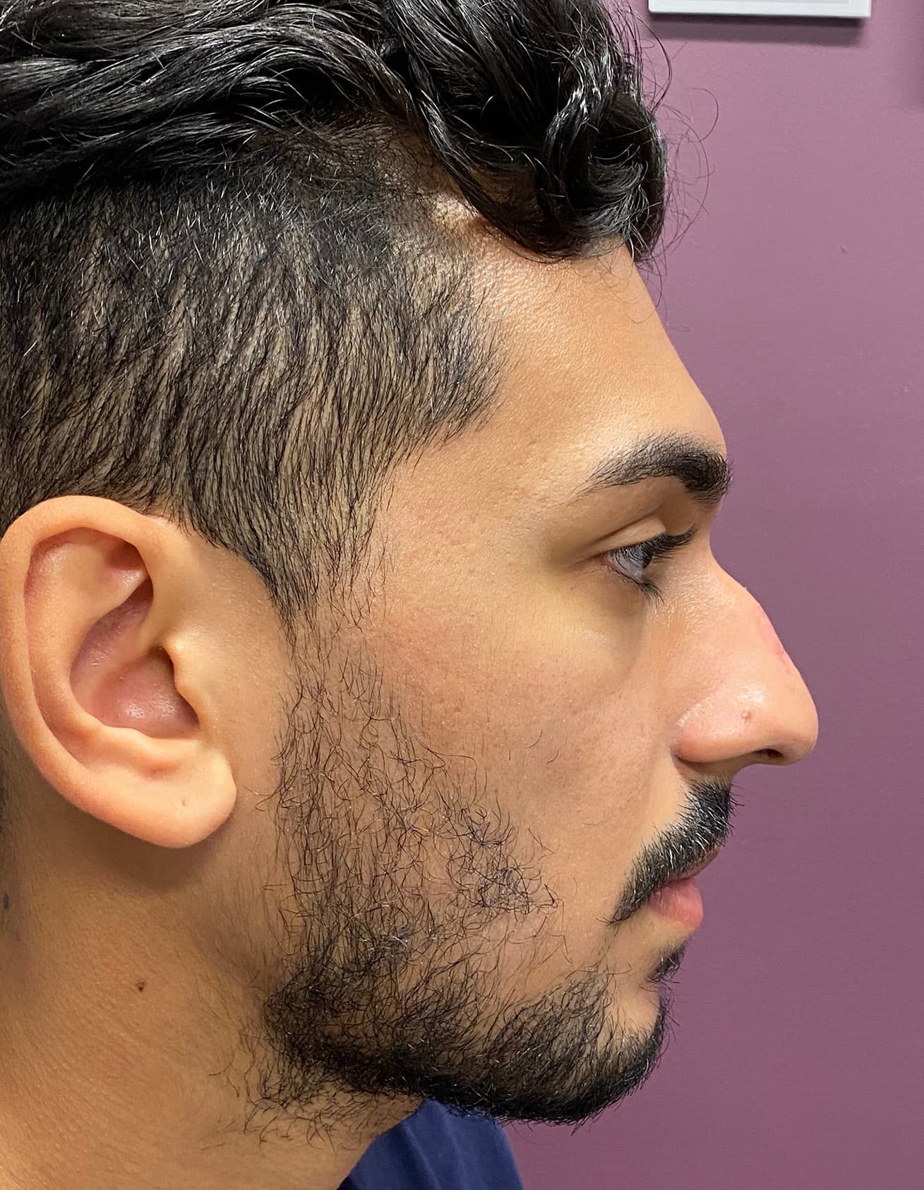 rhinoplasty before, patient 87168865, Dr. Shari Reitzen, New York