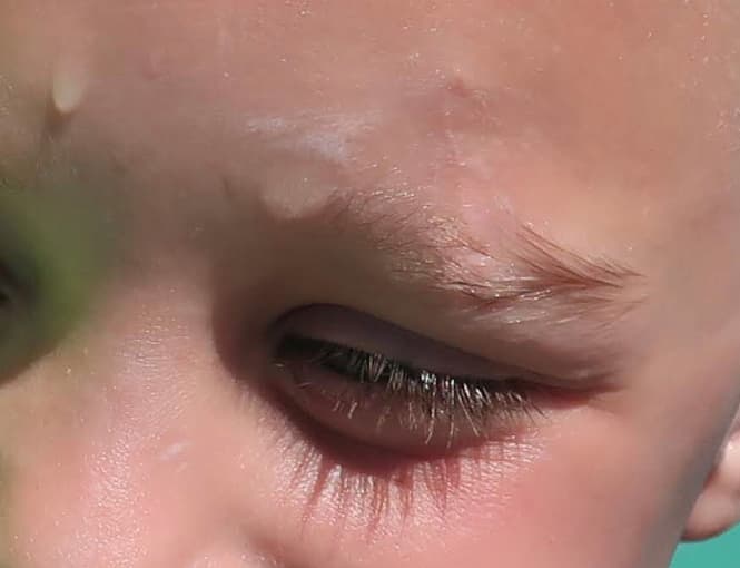 scar revision after, patient 87168884, Dr. Shari Reitzen, New York