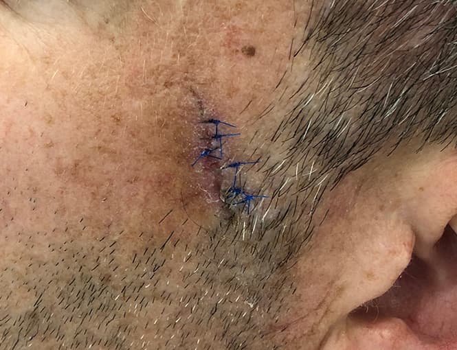 scar revision before, patient 87168883, Dr. Shari Reitzen, New York