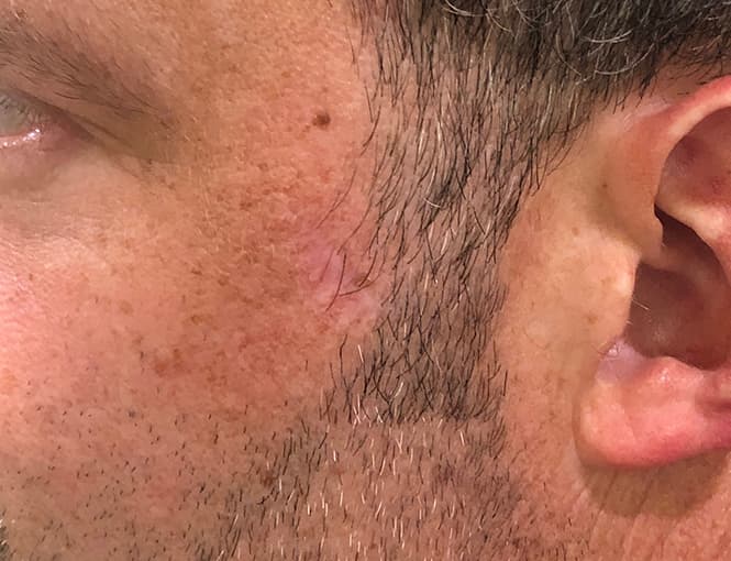 scar revision after, patient 87168883, Dr. Shari Reitzen, New York