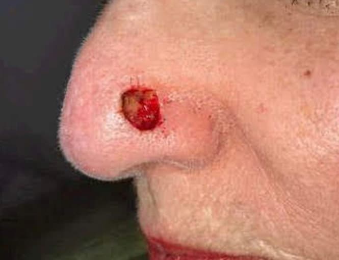 skin cancer reconstruction before, patient 91459441, Dr. Shari Reitzen, New York