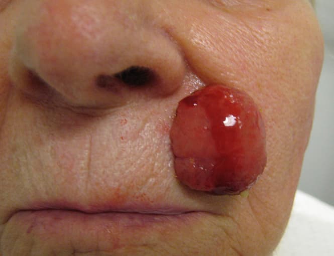 skin cancer reconstruction before, patient 91459478, Dr. Shari Reitzen, New York