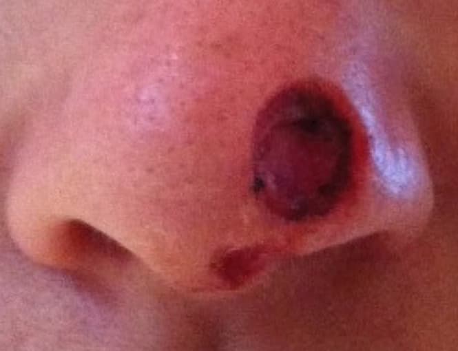 skin cancer reconstruction before, patient 91459479, Dr. Shari Reitzen, New York