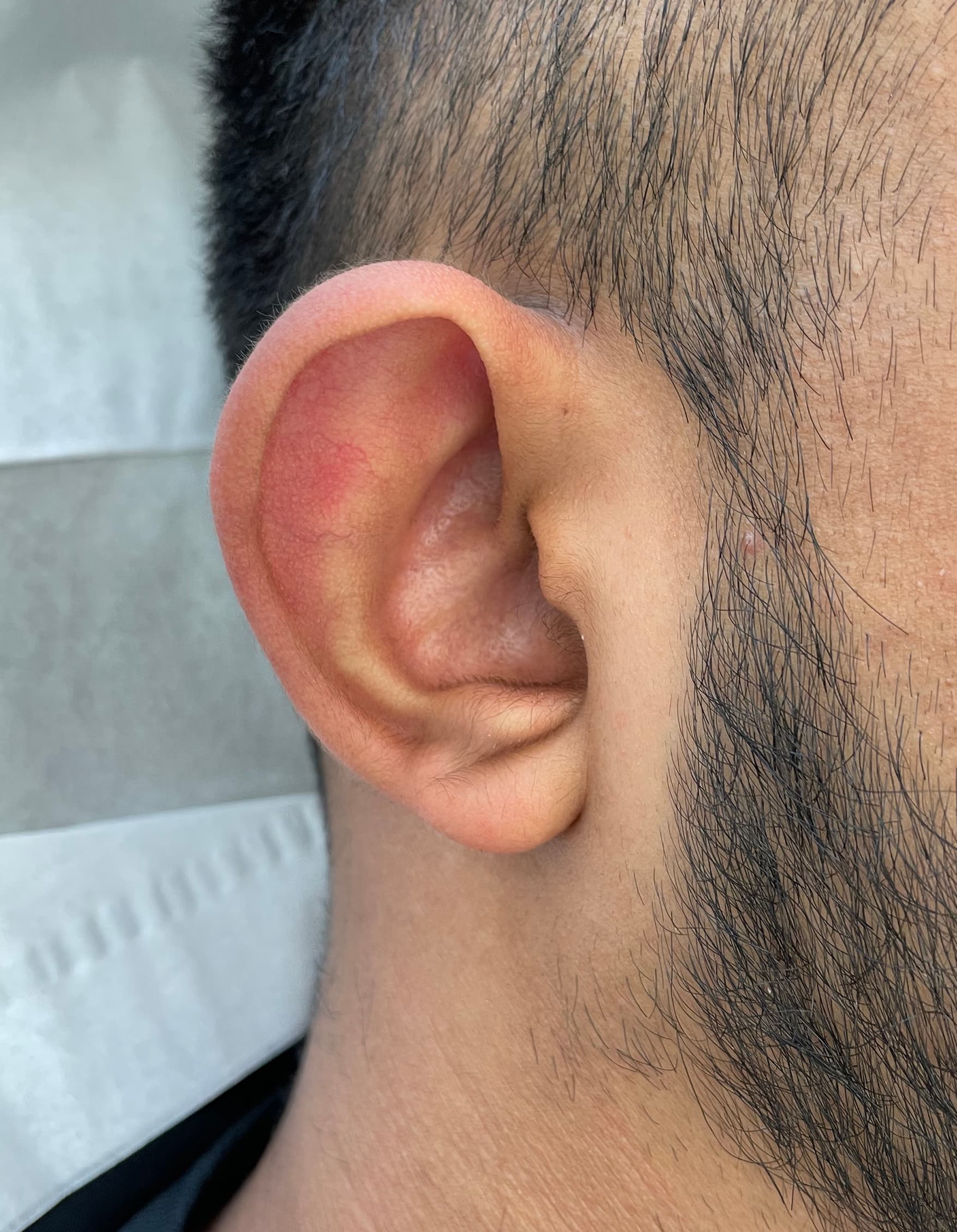 otoplasty before, patient 89184944, Dr. Shari Reitzen, New York