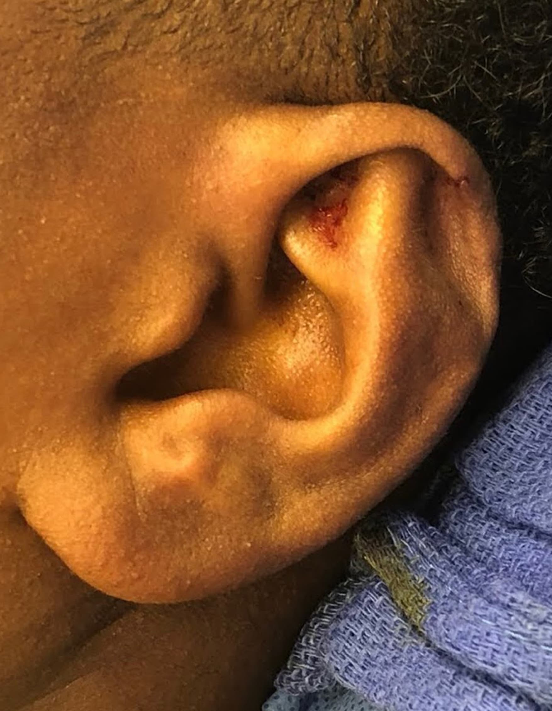 otoplasty after, patient 91459495, Dr. Shari Reitzen, New York