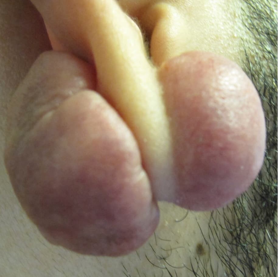 keloid removal before, patient 90379453, Dr. Shari Reitzen, New York