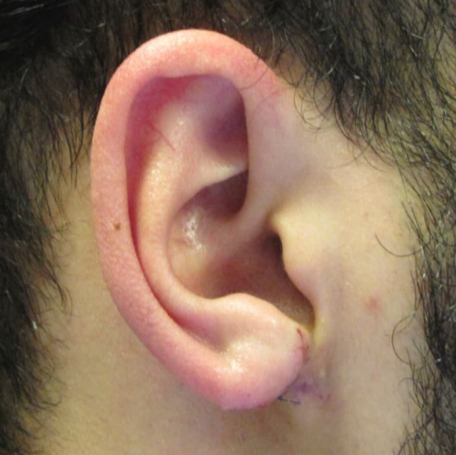 keloid removal after, patient 90379453, Dr. Shari Reitzen, New York