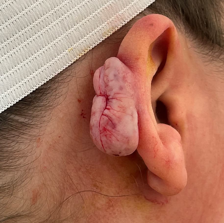 keloid removal before, patient 90379452, Dr. Shari Reitzen, New York