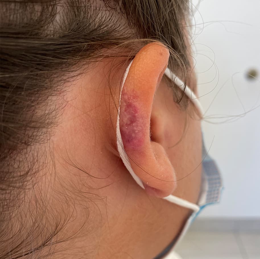 keloid removal after, patient 90379452, Dr. Shari Reitzen, New York