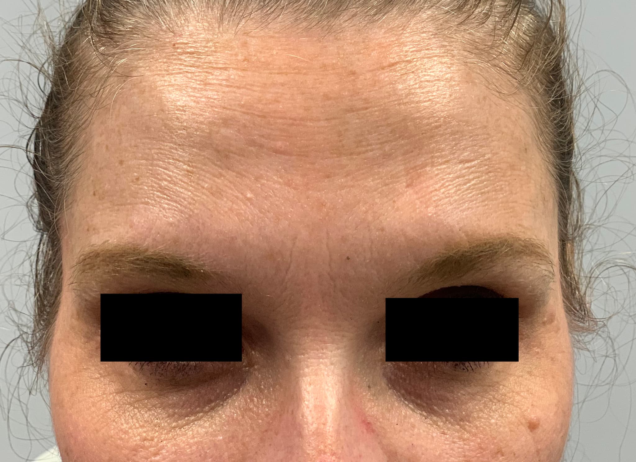 botox after, patient 87168896, Dr. Shari Reitzen, New York