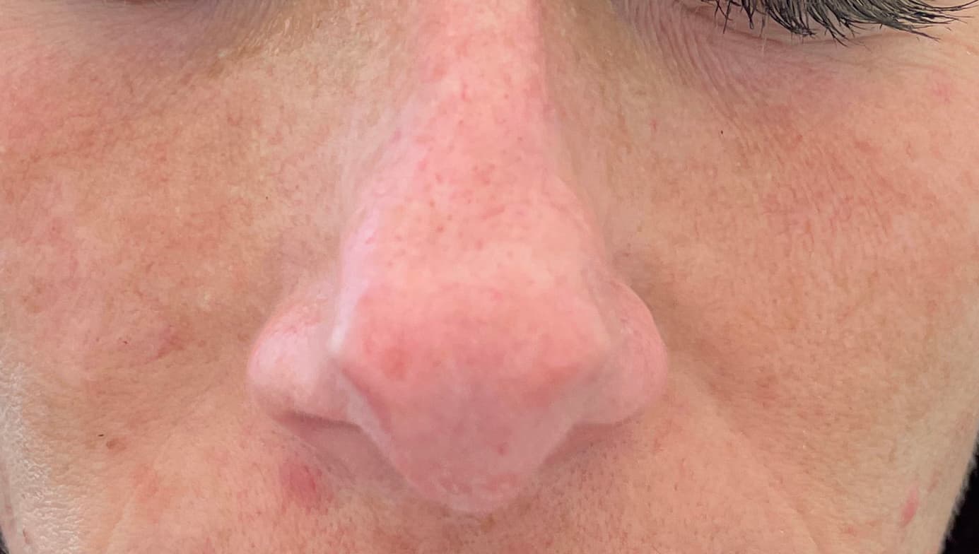 non surgical rhinoplasty before, patient 90401946, Dr. Shari Reitzen, New York