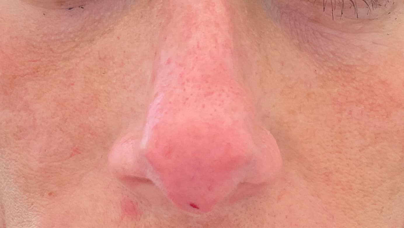 non surgical rhinoplasty after, patient 90401946, Dr. Shari Reitzen, New York