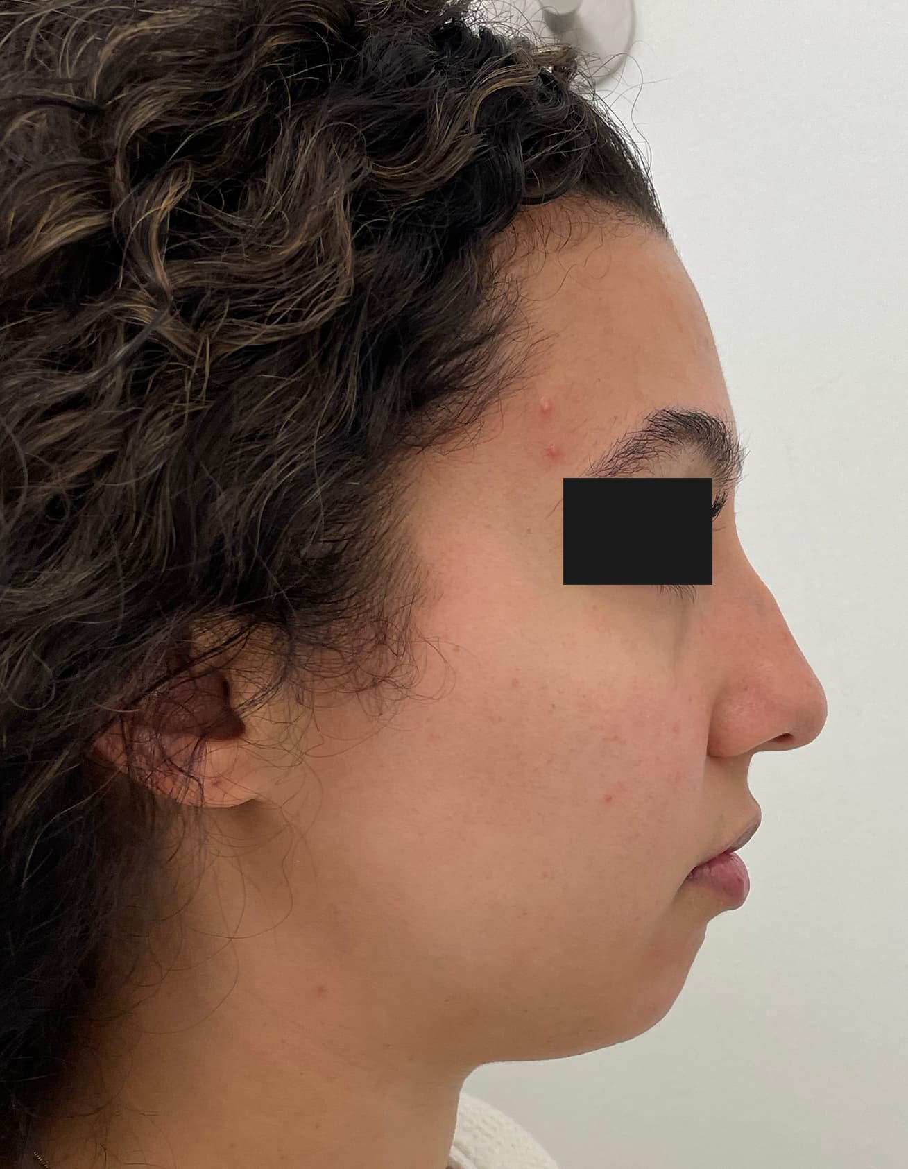 fillers before, patient 91459559, Dr. Shari Reitzen, New York