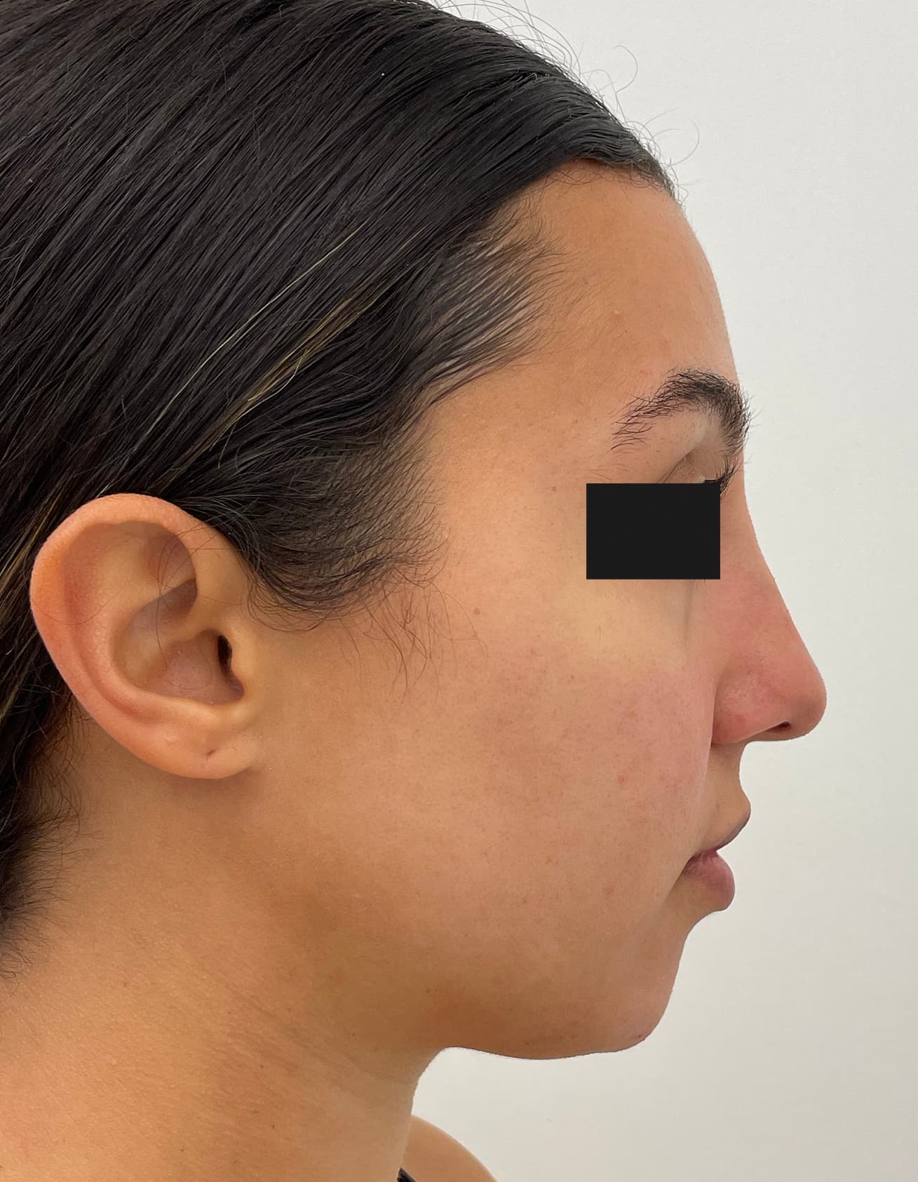 fillers after, patient 91459559, Dr. Shari Reitzen, New York