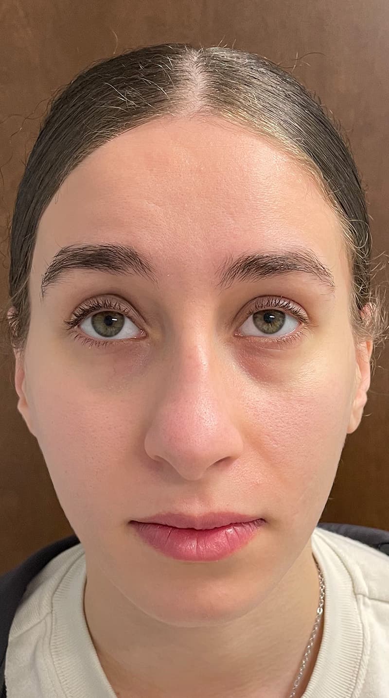 rhinoplasty before, patient 122833306, Dr. Shari Reitzen, New York
