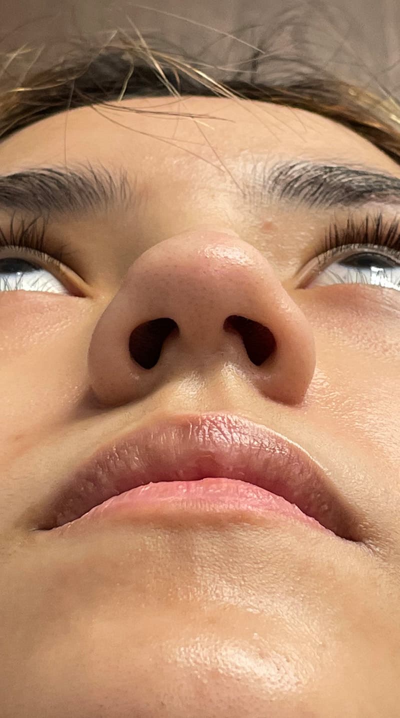 rhinoplasty before, patient 122833308, Dr. Shari Reitzen, New York
