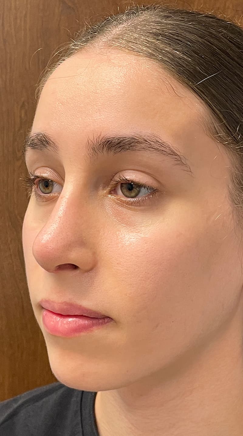 rhinoplasty after, patient 122833306, Dr. Shari Reitzen, New York