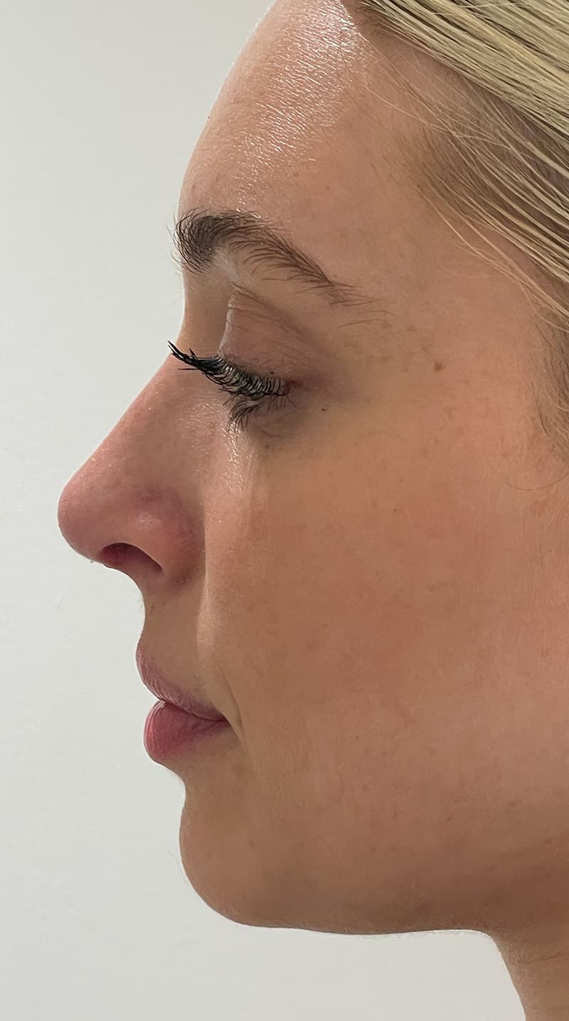 rhinoplasty after, patient 141547529, Dr. Shari Reitzen, New York