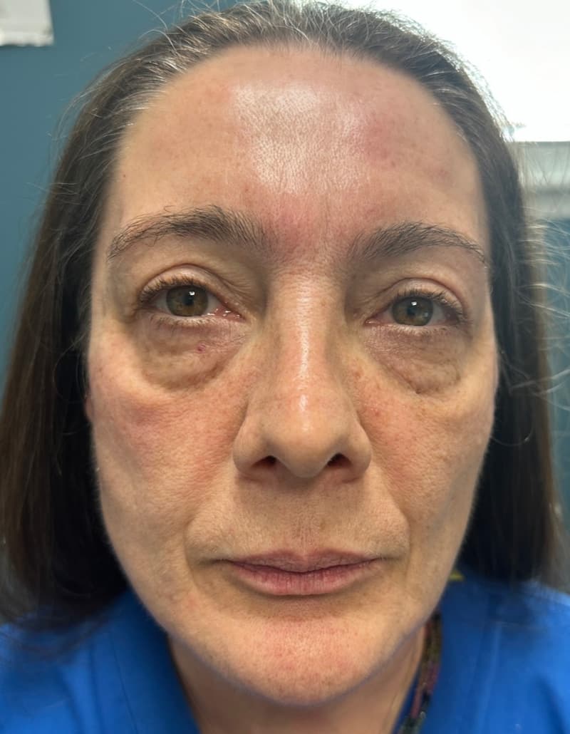 fillers before, patient 148972640, Dr. Shari Reitzen, New York