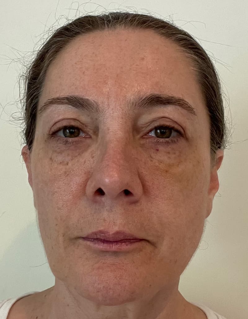 fillers after, patient 148972640, Dr. Shari Reitzen, New York