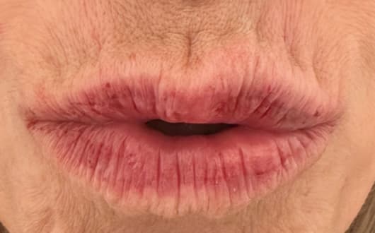 lip augmentation after, patient 148972665, Dr. Shari Reitzen, New York