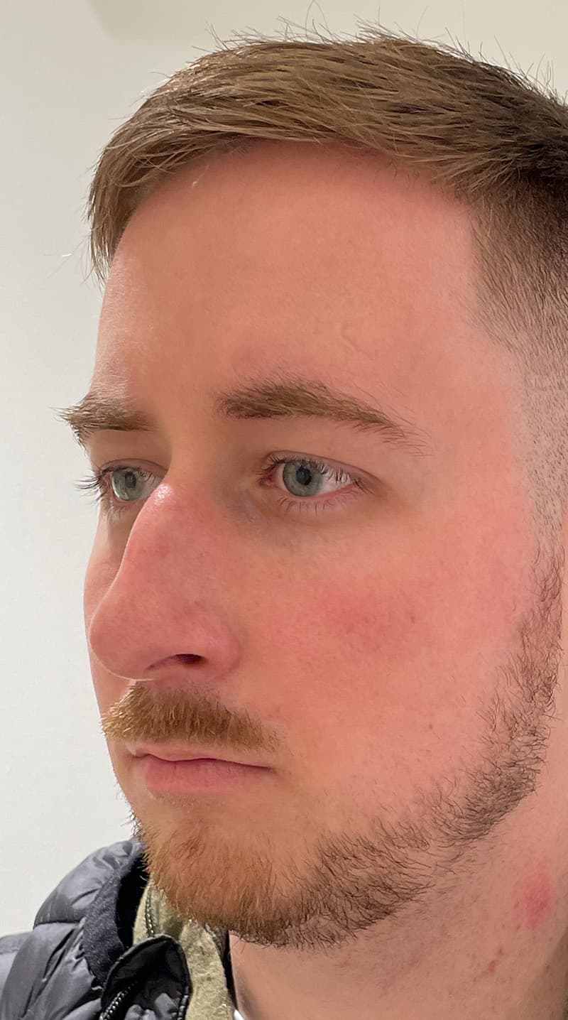 rhinoplasty before, patient 122833307, Dr. Shari Reitzen, New York