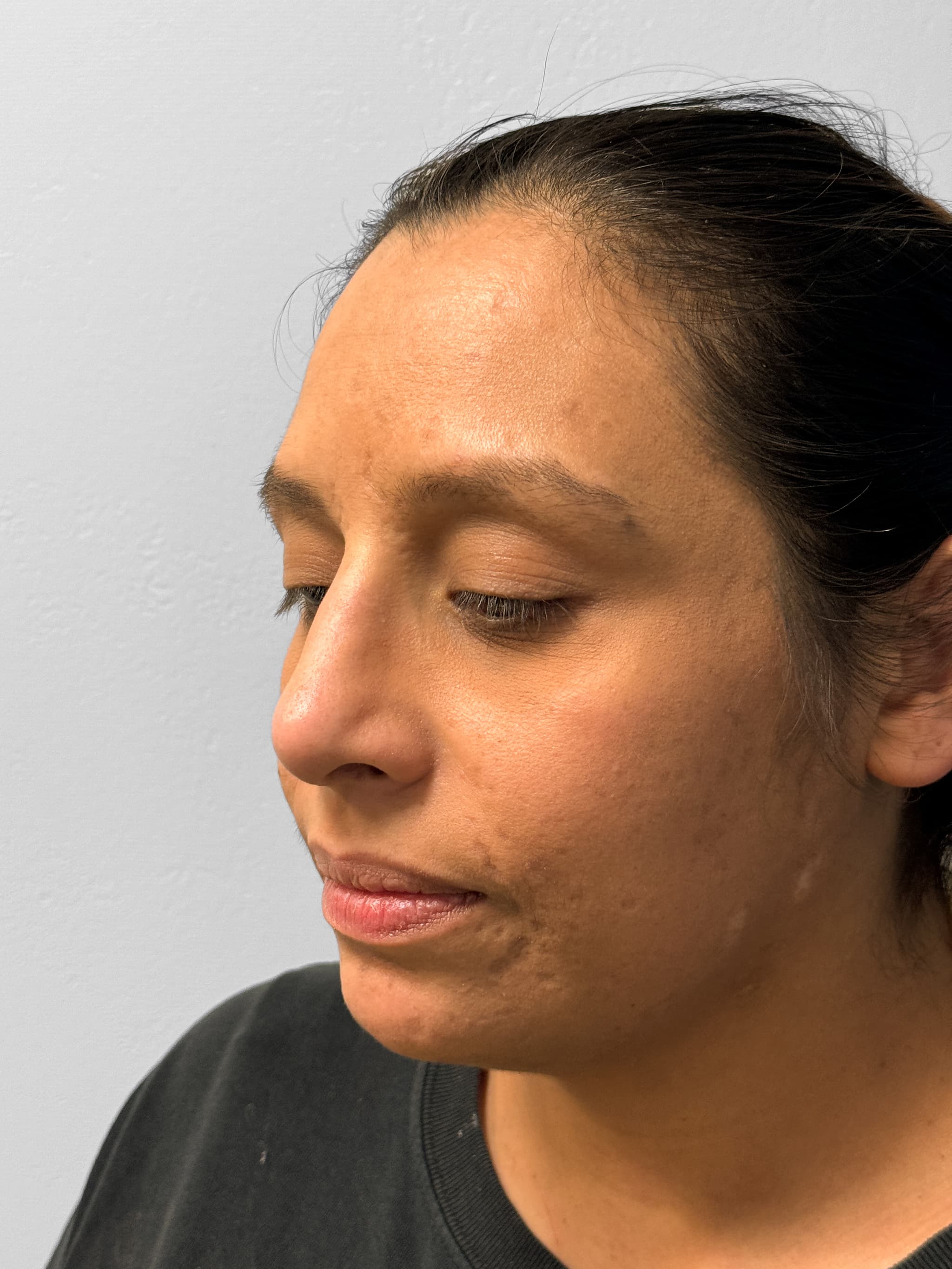 rhinoplasty after, patient LpgWOA3PRnOA-i79TZF0ZQ, Dr. Shari Reitzen, New York