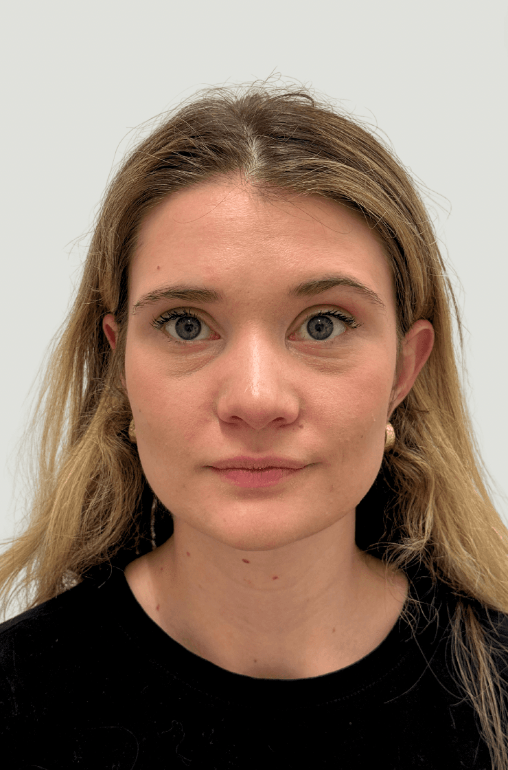rhinoplasty after, patient Zkp3RljfSxuvCHEg6dG4YA, Dr. Shari Reitzen, New York