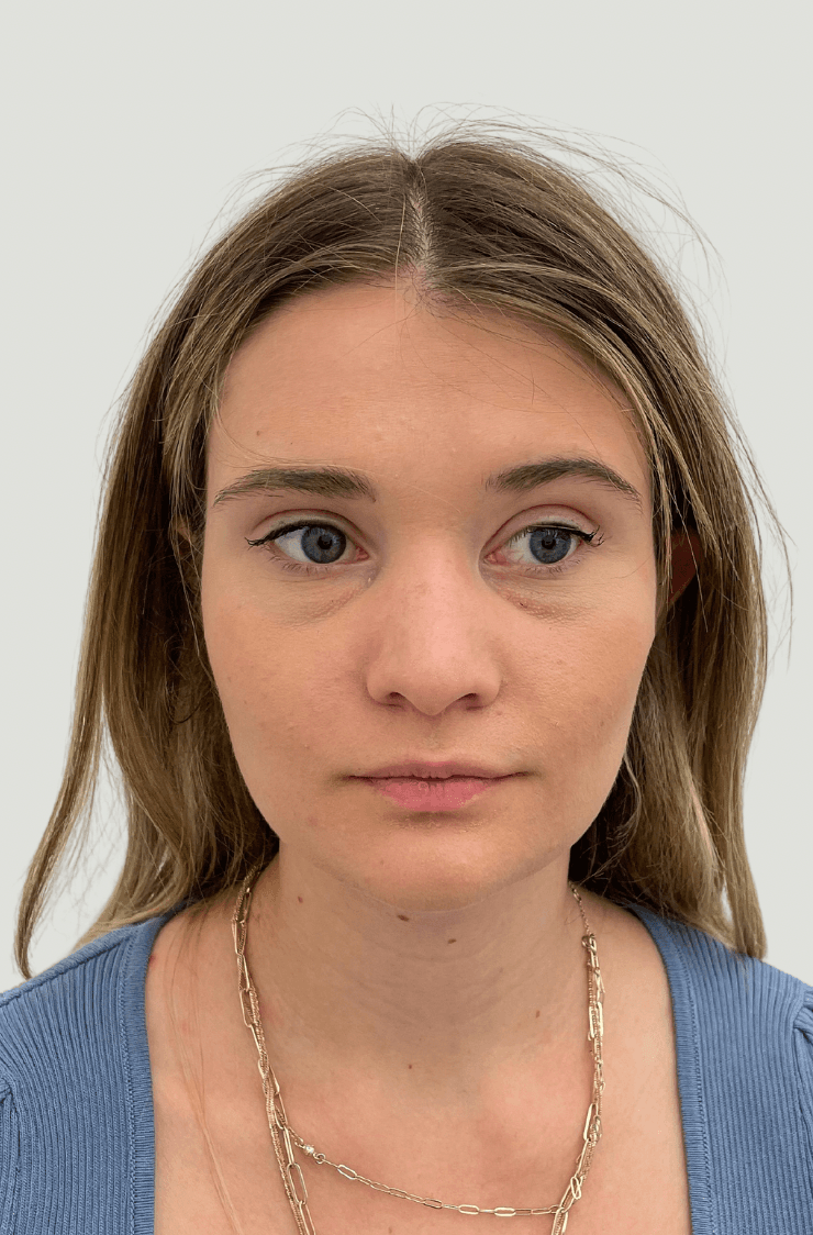 rhinoplasty before, patient Zkp3RljfSxuvCHEg6dG4YA, Dr. Shari Reitzen, New York