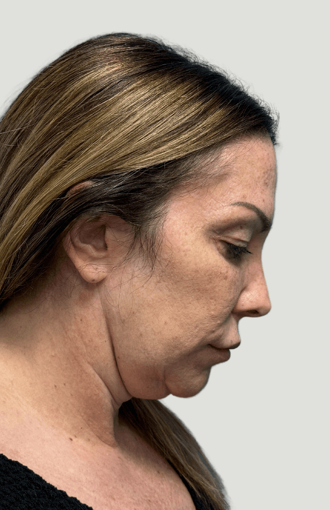 facelift before, patient GENnMgPHQp6Ay4xnWHF85Q, Dr. Shari Reitzen, New York