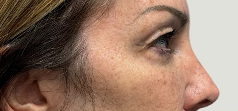 blepharoplasty before, patient SVGHWB74RN-bEx4l-0_4qg, Dr. Shari Reitzen, New York