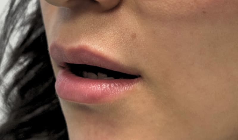 lip augmentation before, patient MdcKgi8qSPevtXkRtFodFQ, Dr. Shari Reitzen, New York