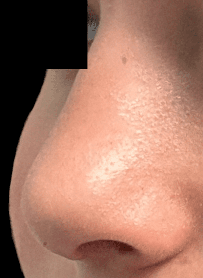 rhinoplasty after, patient Wm4dpuNYRQme5SzPsgwKhQ, Dr. Shari Reitzen, New York