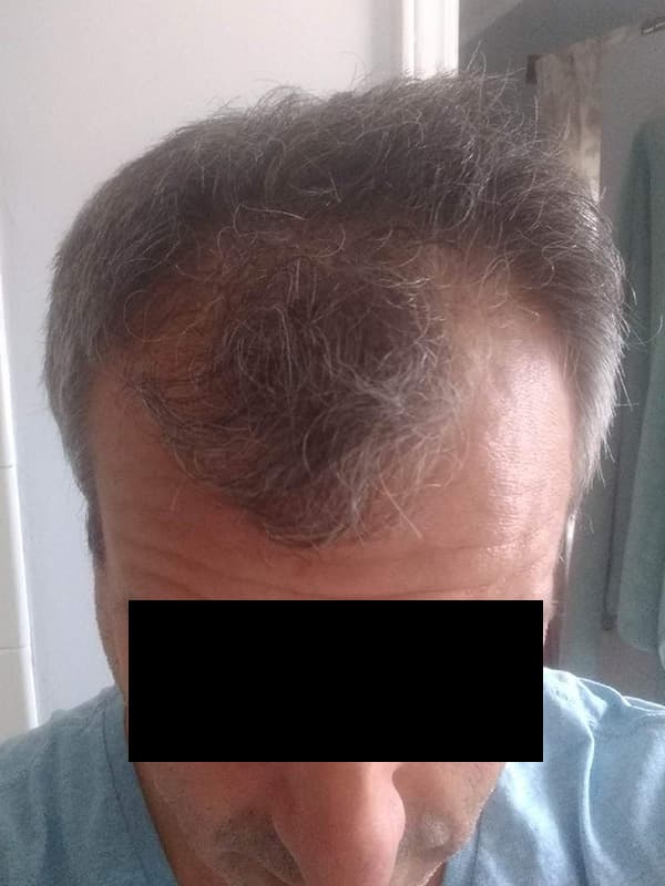 hair transplantation before, patient SjNtF1bOTYKLE555tZNaaA, Dr. Shari Reitzen, New York