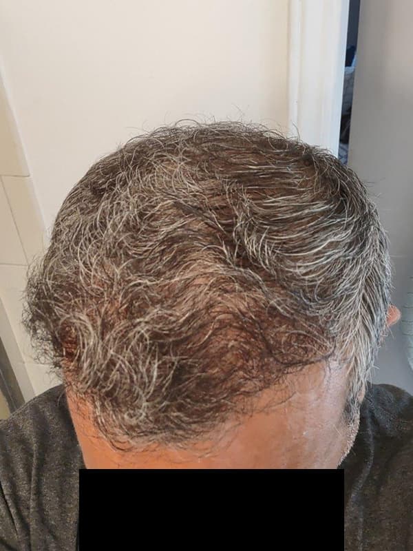 hair transplantation after, patient SjNtF1bOTYKLE555tZNaaA, Dr. Shari Reitzen, New York