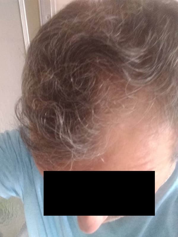 hair transplantation before, patient SjNtF1bOTYKLE555tZNaaA, Dr. Shari Reitzen, New York