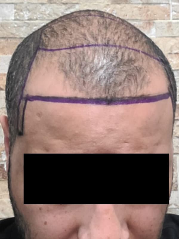 hair transplantation before, patient NiC9lQjoQGeSIQ2653zFrA, Dr. Shari Reitzen, New York