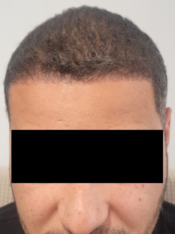 hair transplantation after, patient NiC9lQjoQGeSIQ2653zFrA, Dr. Shari Reitzen, New York