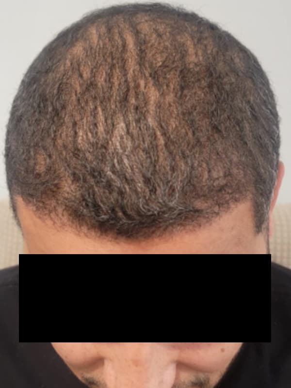hair transplantation after, patient NiC9lQjoQGeSIQ2653zFrA, Dr. Shari Reitzen, New York