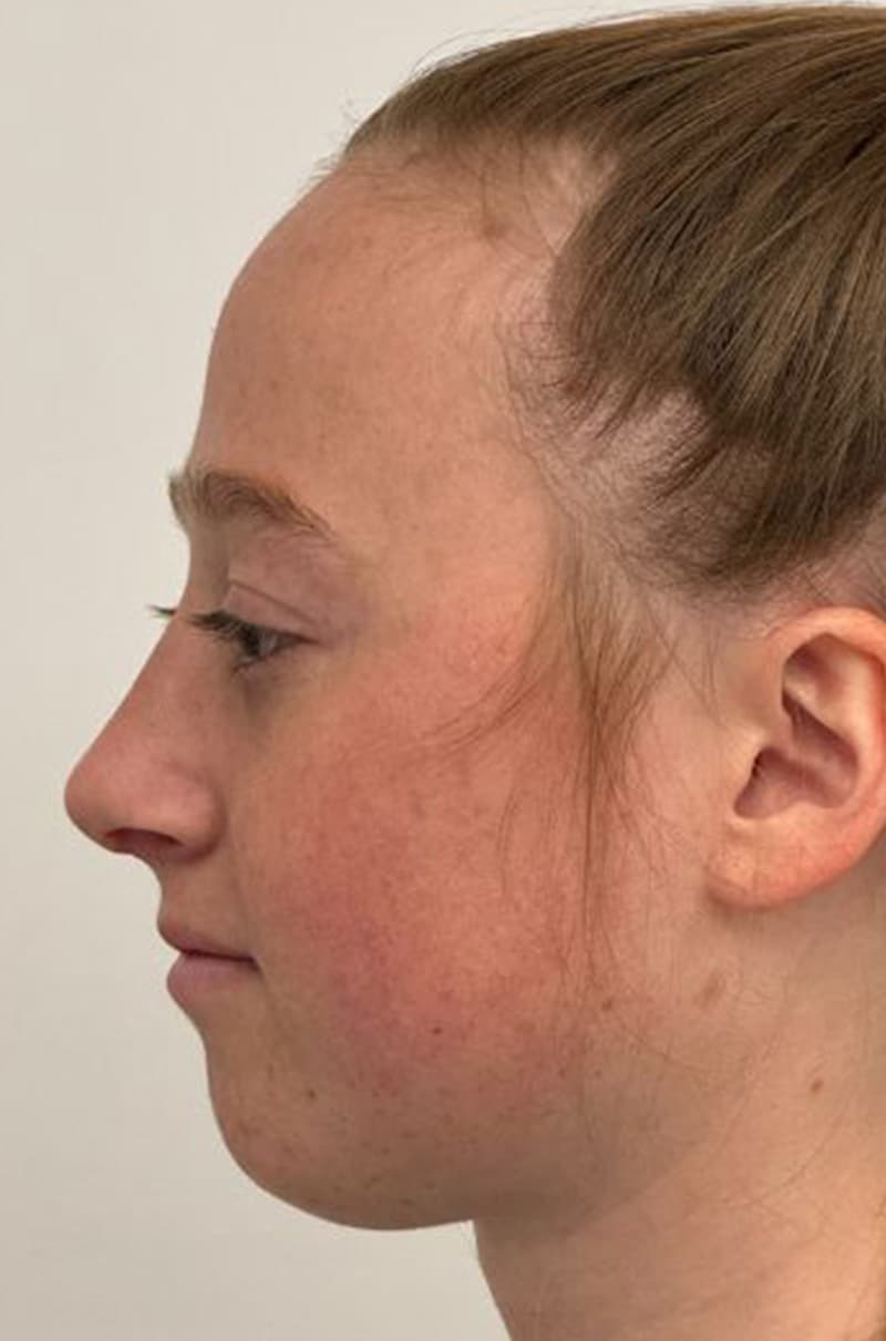 rhinoplasty after, patient Ft9gnr-DSUKMEVB3ya75IA, Dr. Shari Reitzen, New York