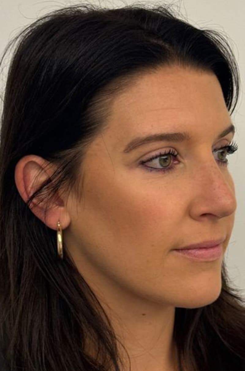 rhinoplasty after, patient Y475wahjSlKb7sLeNXpjUQ, Dr. Shari Reitzen, New York